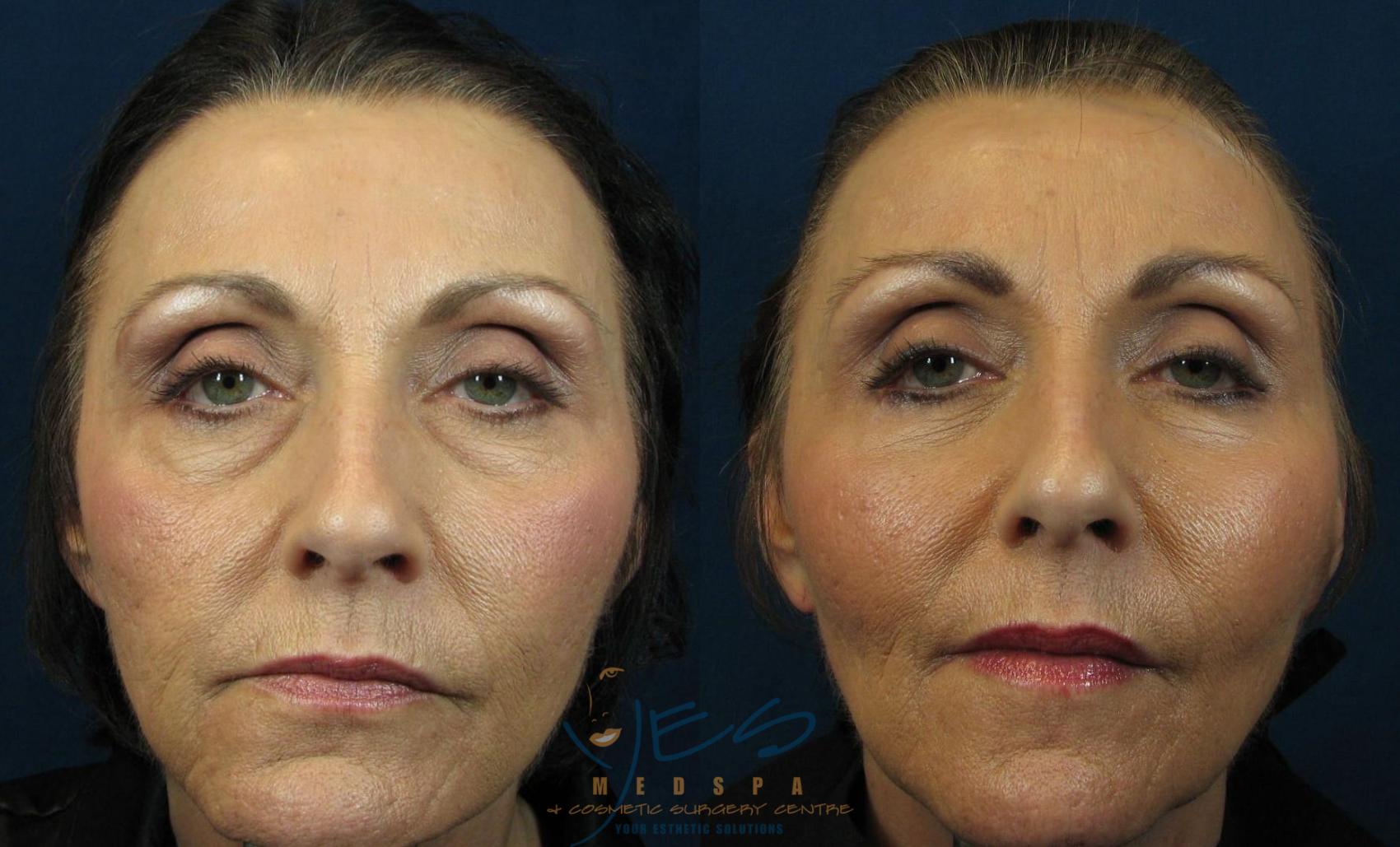 Before & After Lower Eyelid Blepharoplasty Case 41 View #1 View in Vancouver, BC