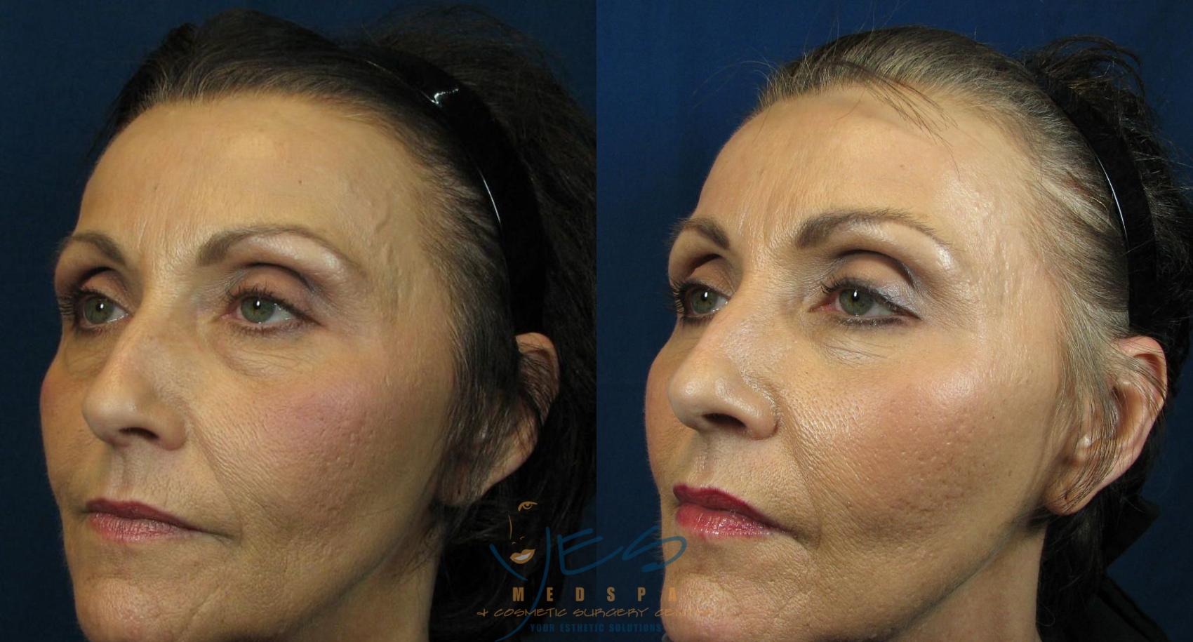 Before & After Lower Eyelid Blepharoplasty Case 41 View #2 View in Vancouver, BC