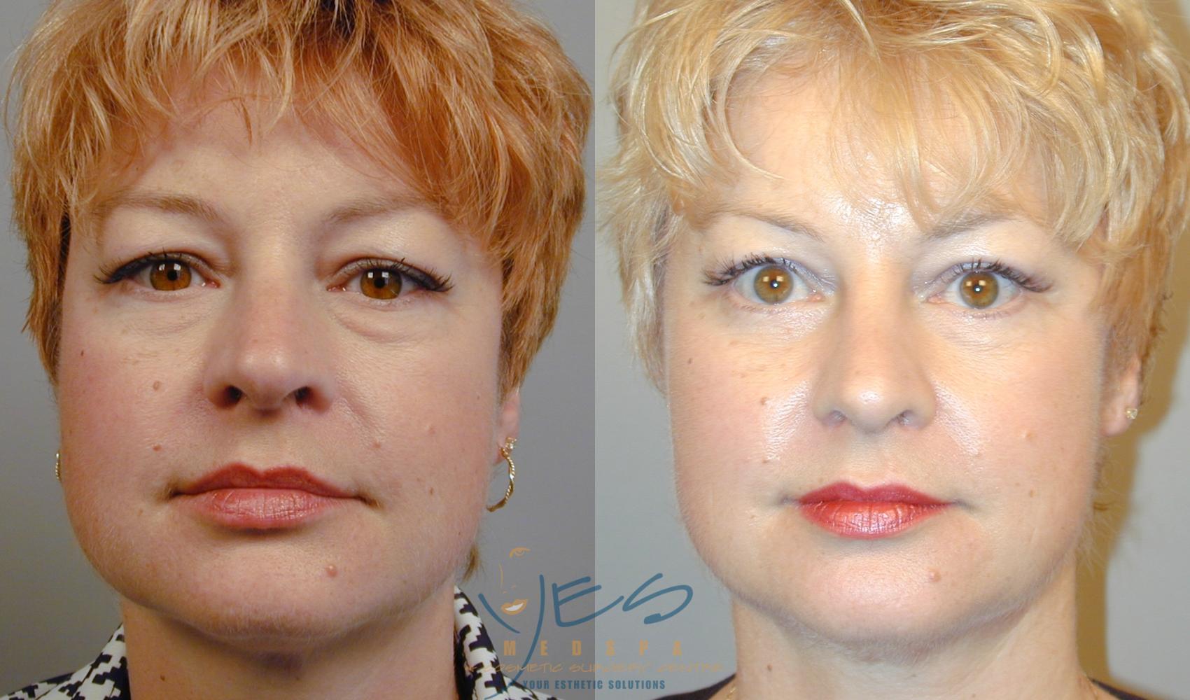 Before & After Lower Eyelid Blepharoplasty Case 43 View #1 View in Vancouver, BC