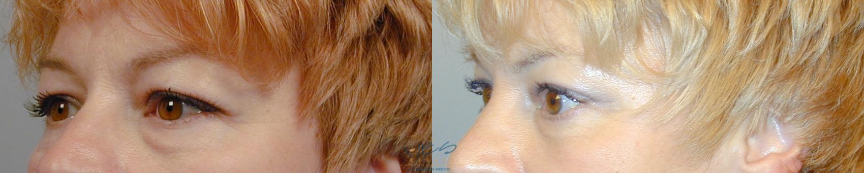Before & After Lower Eyelid Blepharoplasty Case 43 View #2 View in Vancouver, BC