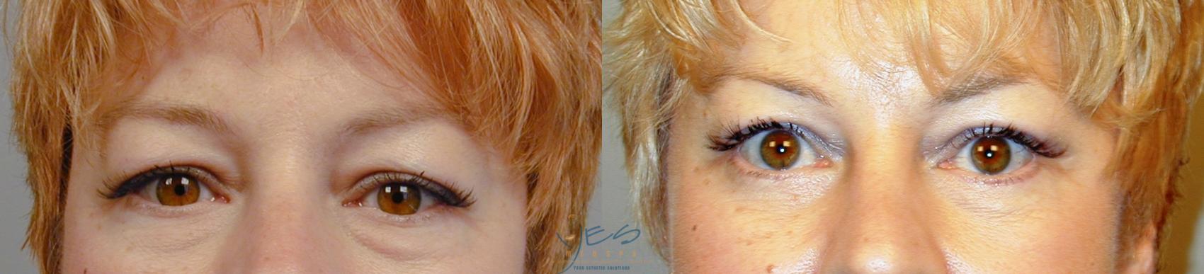 Before & After Lower Eyelid Blepharoplasty Case 43 View #3 View in Vancouver, BC