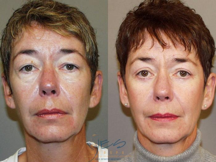 Before & After Lower Eyelid Blepharoplasty Case 45 View #1 View in Vancouver, BC