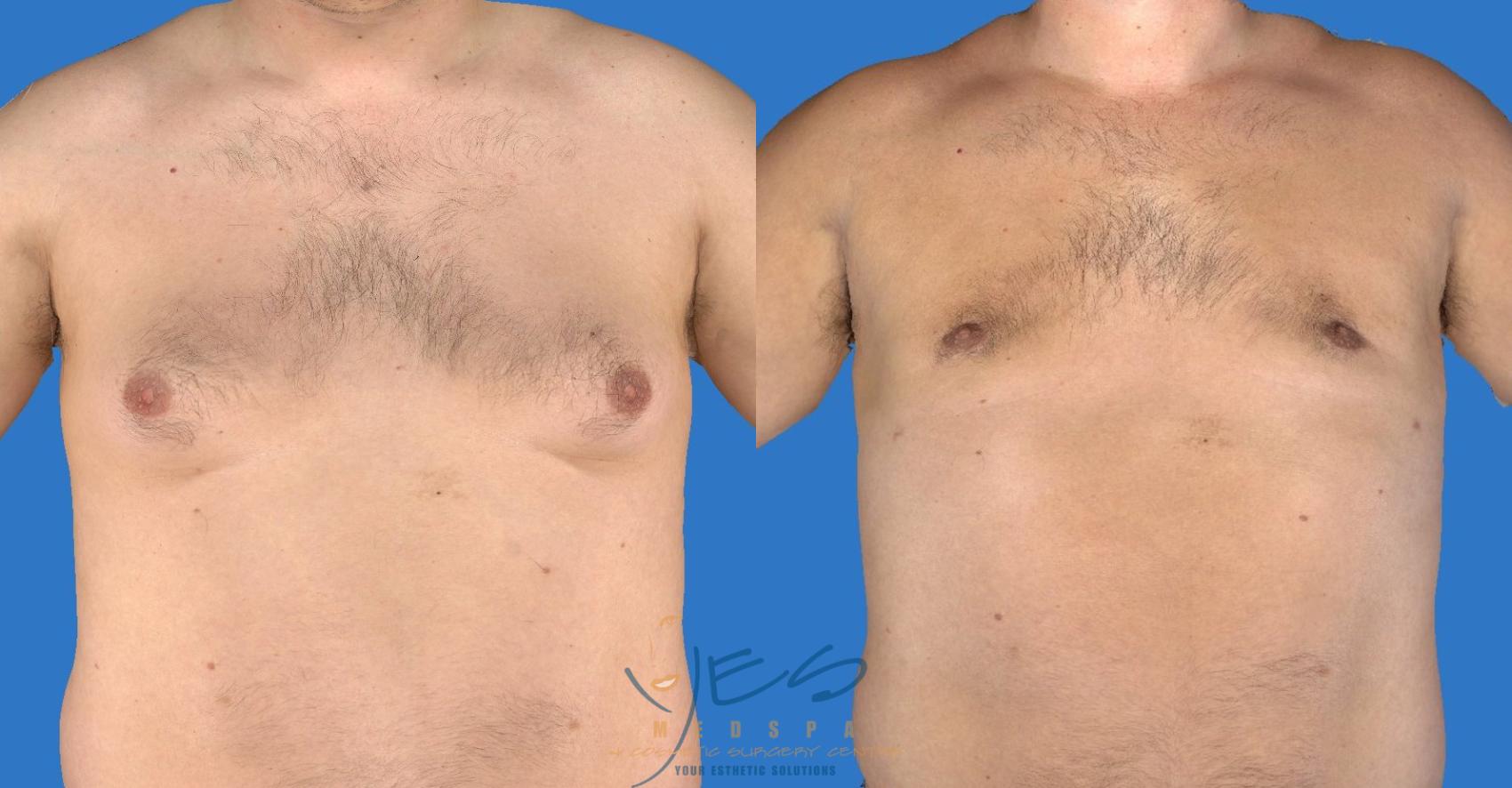 Before & After Male Breast Reduction Case 126 View #1 View in Vancouver, BC