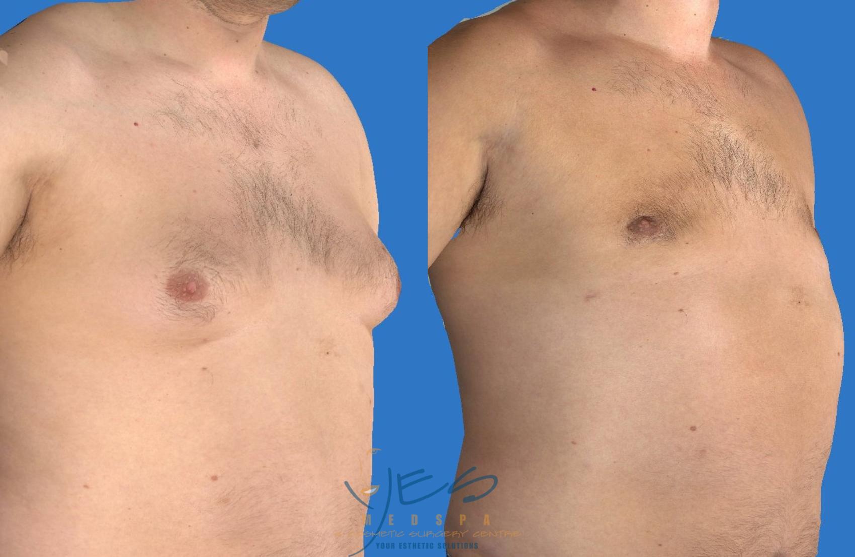 Before & After Male Breast Reduction Case 126 View #2 View in Vancouver, BC