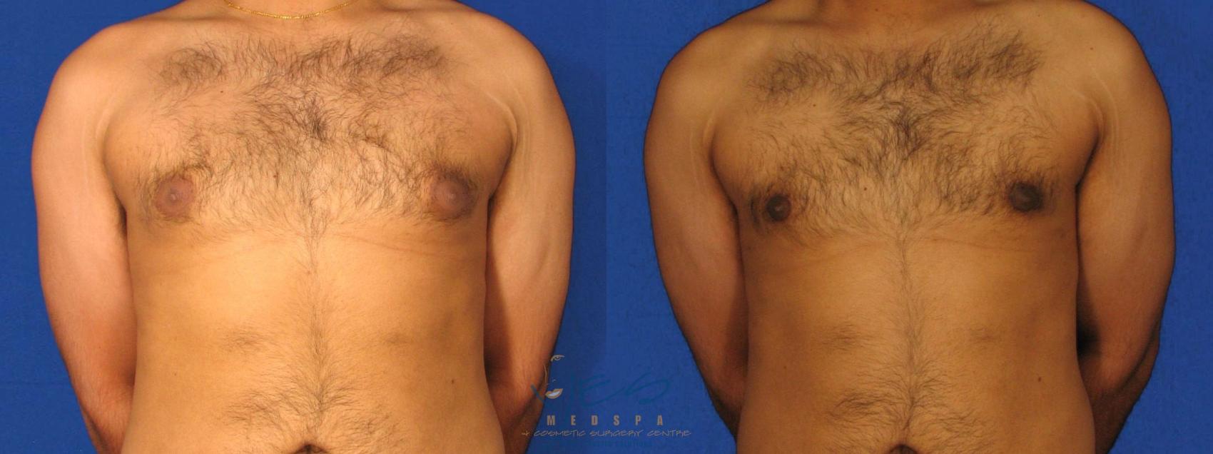 Before & After Male Breast Reduction Case 13 View #1 View in Vancouver, BC