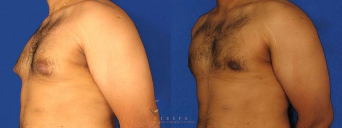 Before & After Male Breast Reduction Case 13 View #2 View in Vancouver, BC