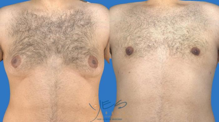 Before & After SmartLipo™ Case 130 Front View in Vancouver, BC