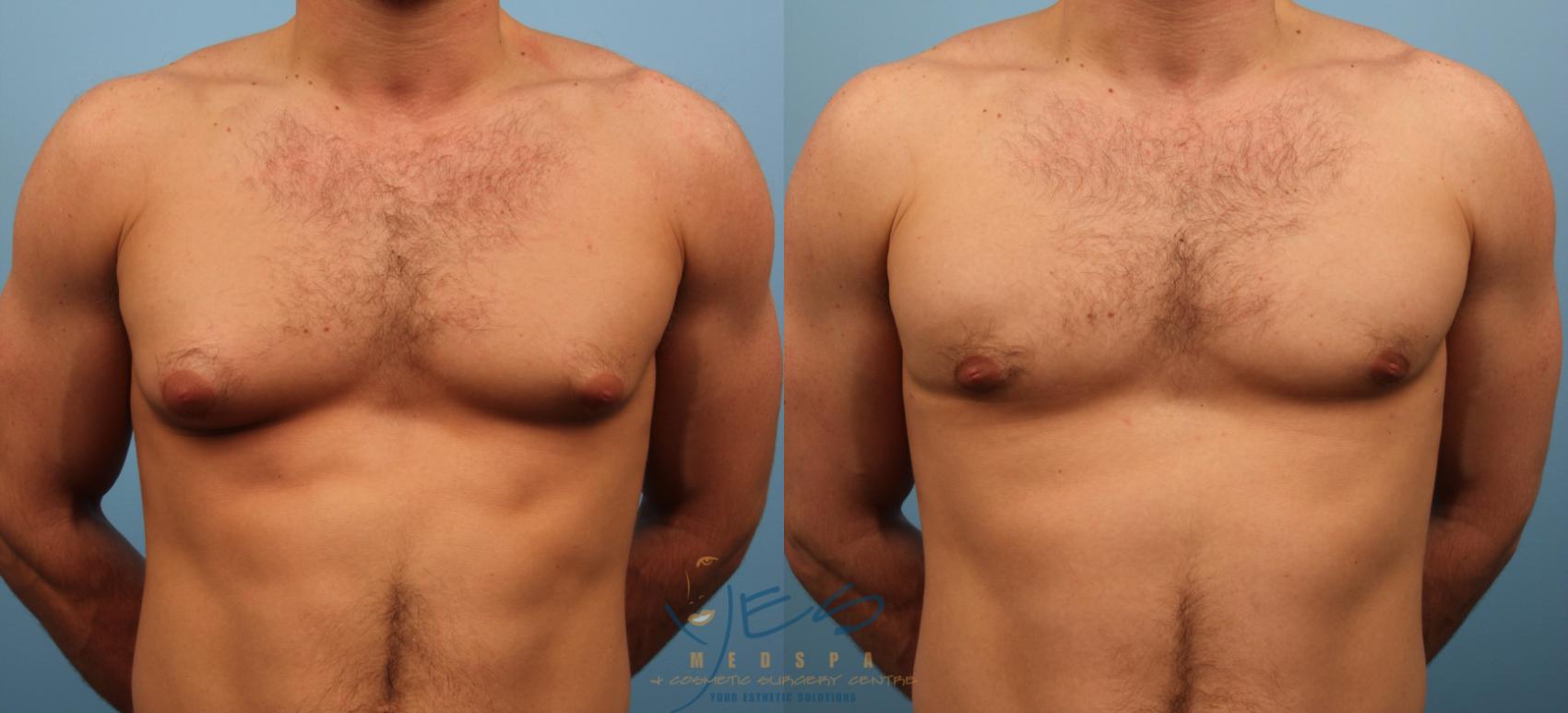Before & After Male Breast Reduction Case 138 View #1 View in Vancouver, BC