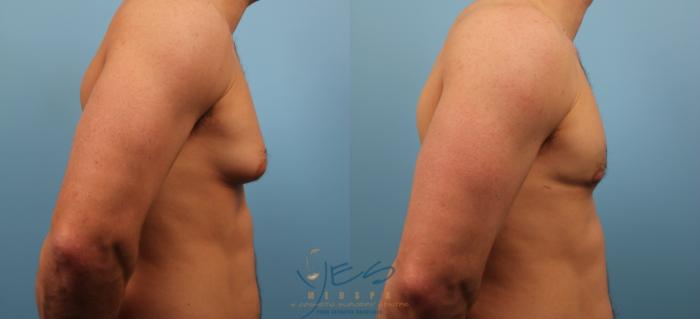 Before & After Male Breast Reduction Case 138 View #2 View in Vancouver, BC