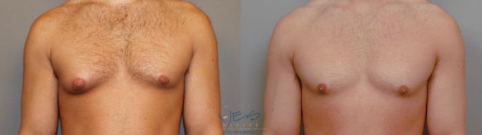 Before & After Male Breast Reduction Case 14 View #1 View in Vancouver, BC