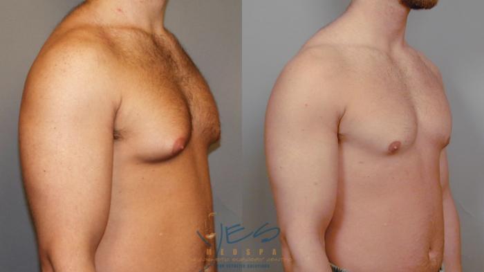 Before & After Male Breast Reduction Case 14 View #2 View in Vancouver, BC