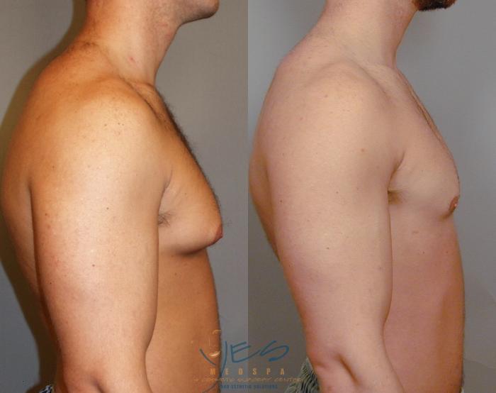 Before & After Male Breast Reduction Case 14 View #3 View in Vancouver, BC