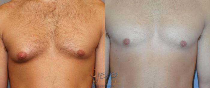Before & After Male Breast Reduction Case 14 View #4 View in Vancouver, BC