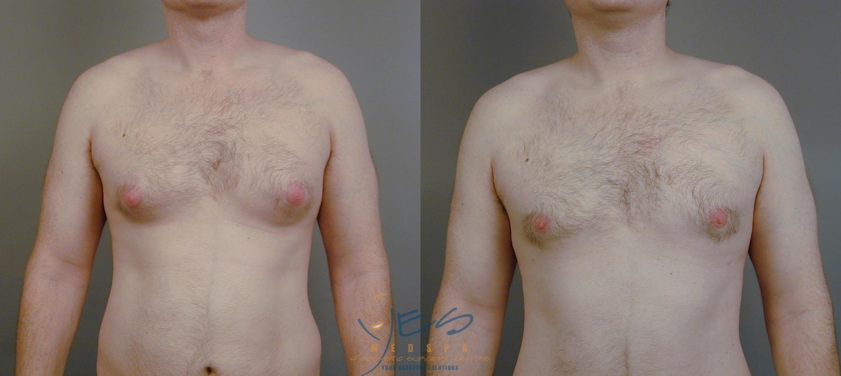 Breast Reduction Patient 1