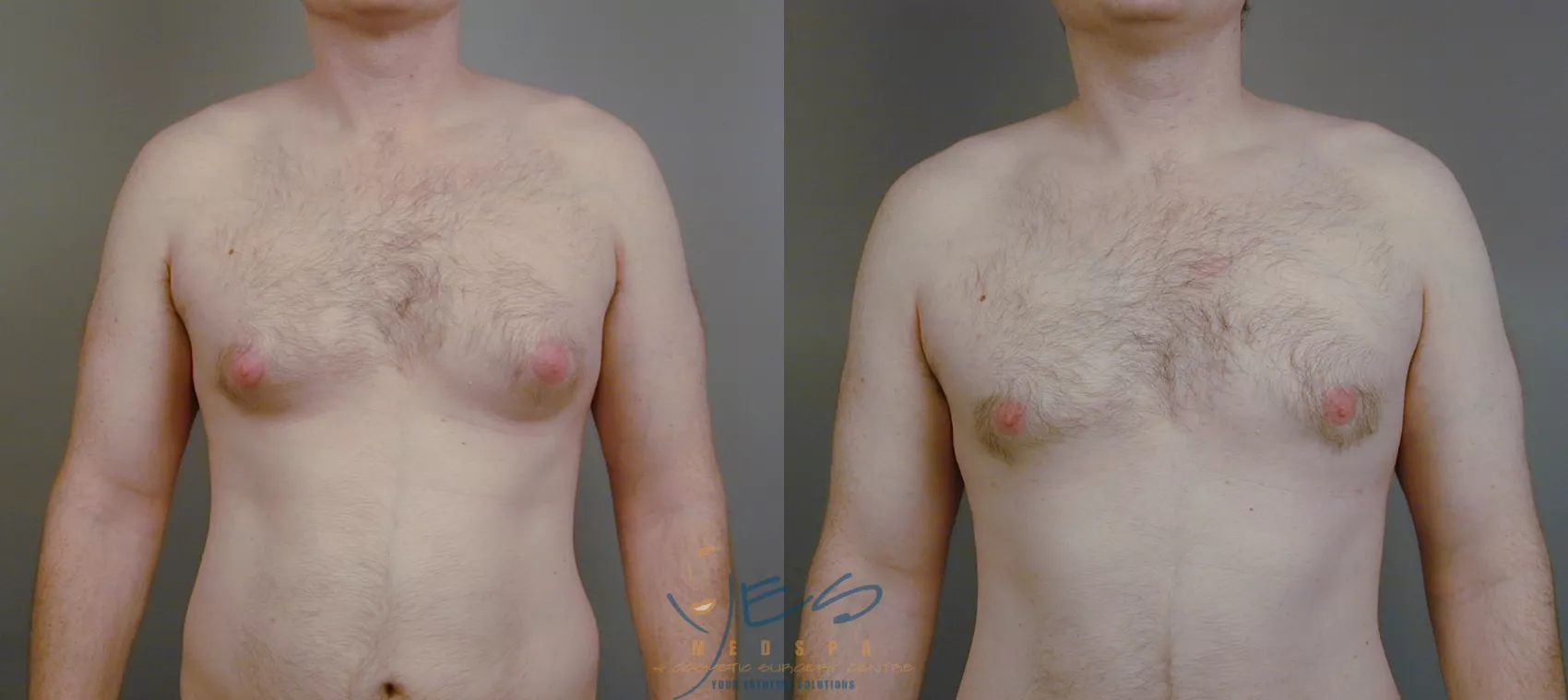 Who Is a Good Candidate for Male Breast Reduction? - Folsom Ca