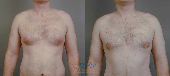 Before & After Male Breast Reduction Case 15 View #1 View in Vancouver, BC