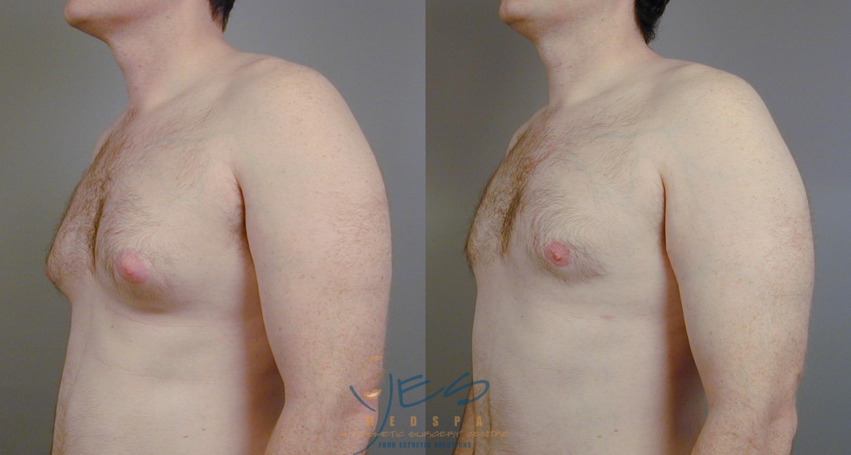 Before & After Male Breast Reduction Case 15 View #2 View in Vancouver, BC