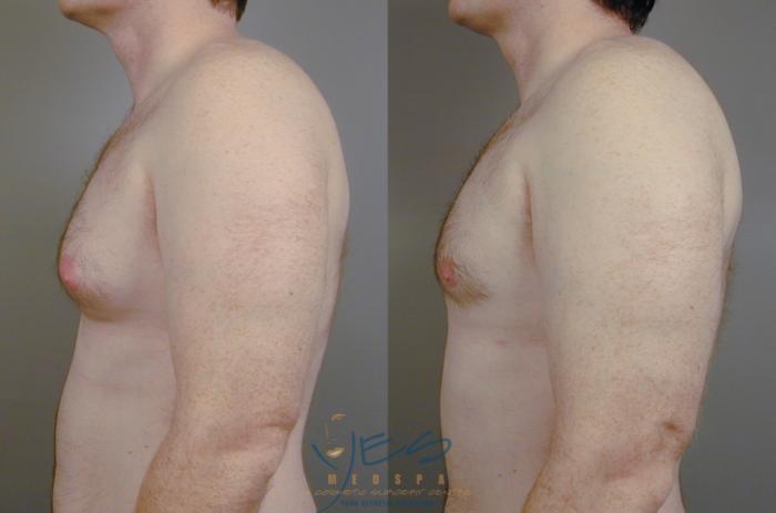 Before & After Male Breast Reduction Case 15 View #3 View in Vancouver, BC