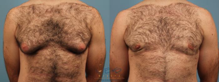 Before & After Male Breast Reduction Case 159 View #1 View in Vancouver, BC