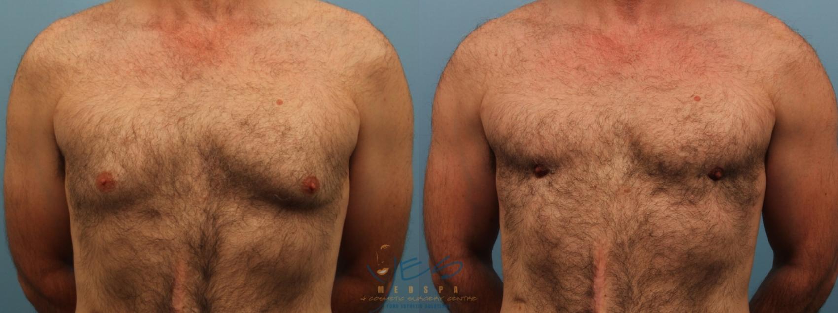 Before & After Male Breast Reduction Case 172 Front View in Vancouver, BC