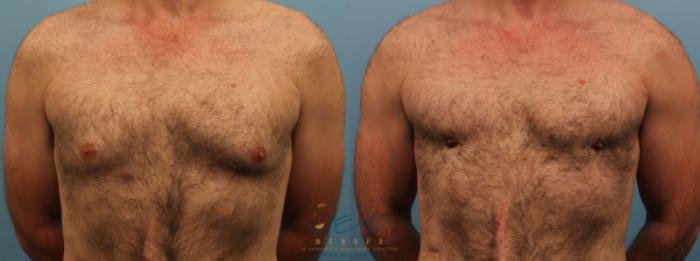 Before & After SmartLipo™ Case 172 Front View in Vancouver, BC