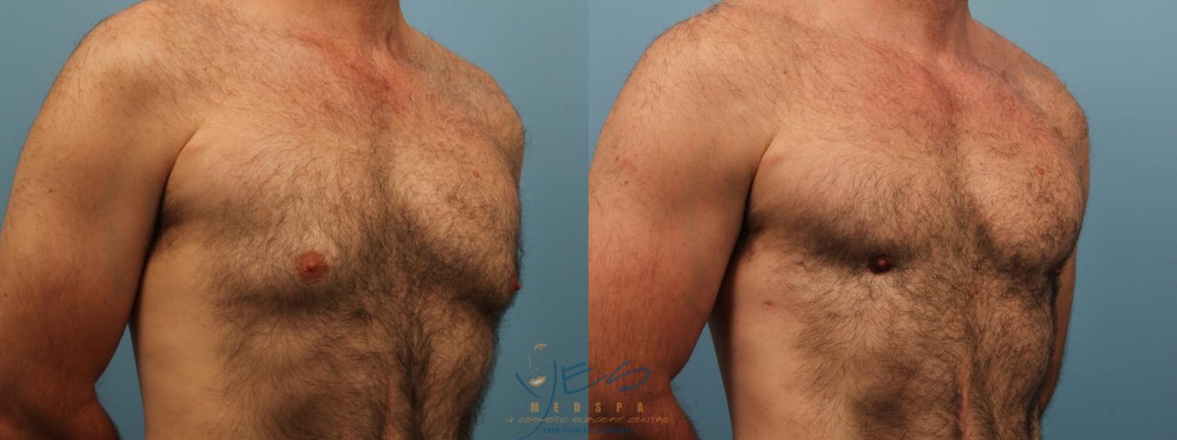 Before & After Male Breast Reduction Case 172 Right Oblique View in Vancouver, BC