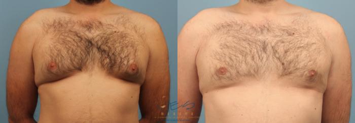 Before & After Male Breast Reduction Case 189 View #1 View in Vancouver, BC