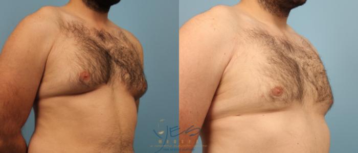 Before & After Male Breast Reduction Case 189 View #2 View in Vancouver, BC
