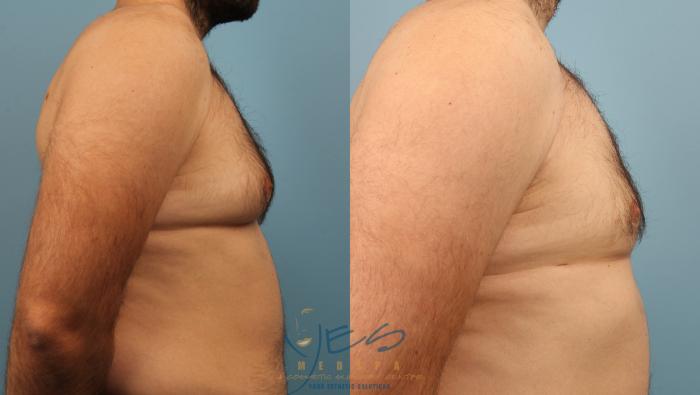 Before & After Male Breast Reduction Case 189 View #3 View in Vancouver, BC