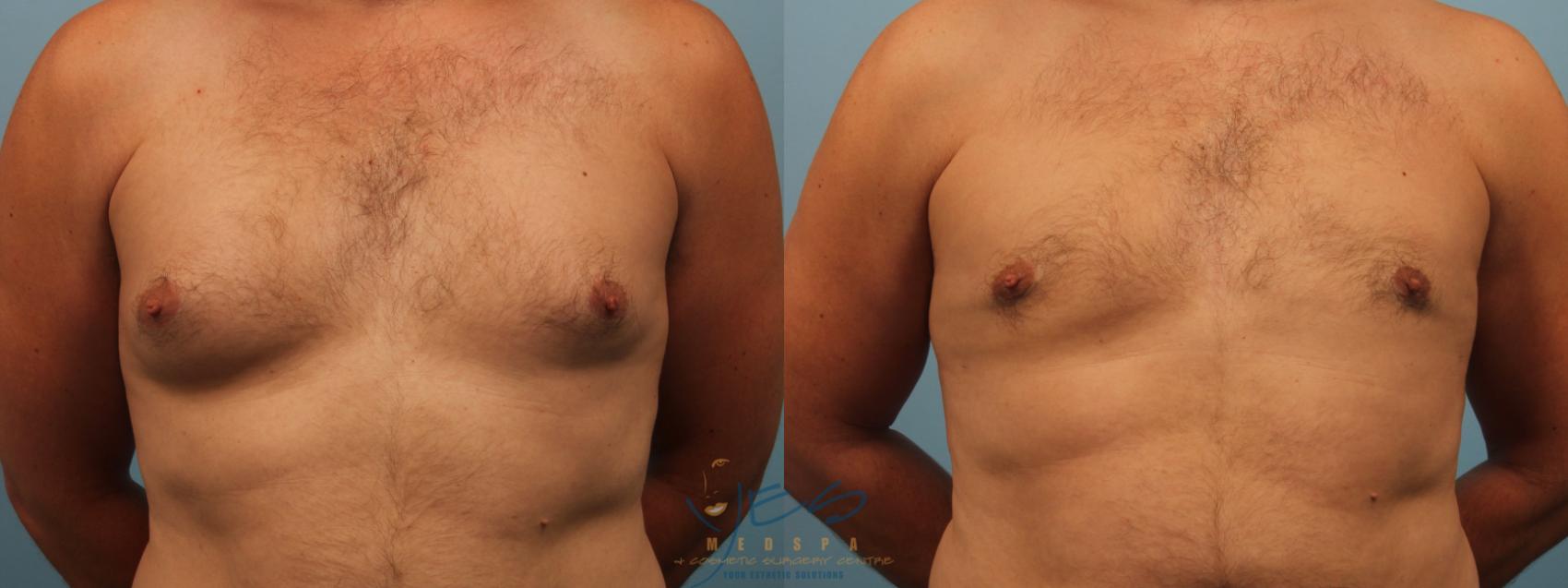 Before & After Male Breast Reduction Case 233 Front View in Vancouver, BC