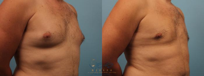 Before & After Male Breast Reduction Case 233 Right Oblique View in Vancouver, BC