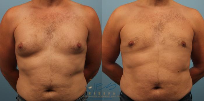 Before & After Male Breast Reduction Case 234 View #1 View in Vancouver, BC