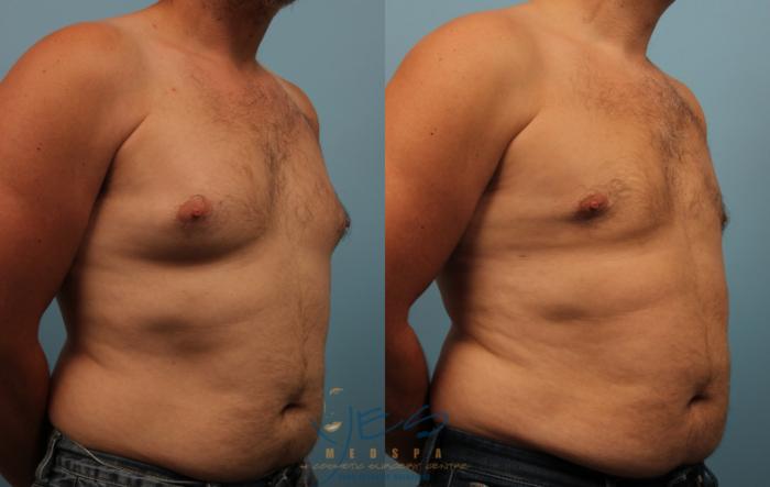 Before & After Male Breast Reduction Case 234 View #2 View in Vancouver, BC