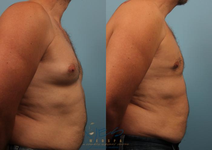Before & After Male Breast Reduction Case 234 View #3 View in Vancouver, BC