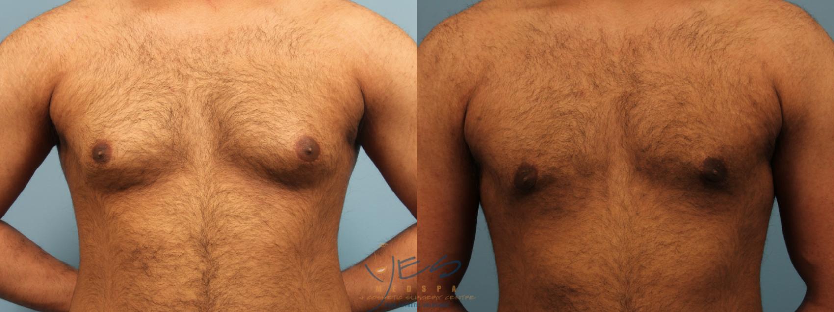 Before & After Male Breast Reduction Case 292 Front View in Vancouver, BC