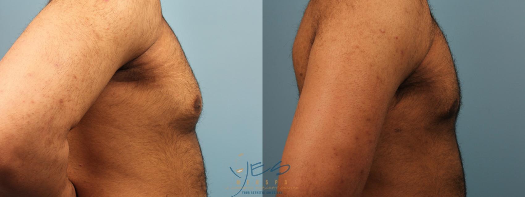 Before & After Male Breast Reduction Case 292 Right Side View in Vancouver, BC
