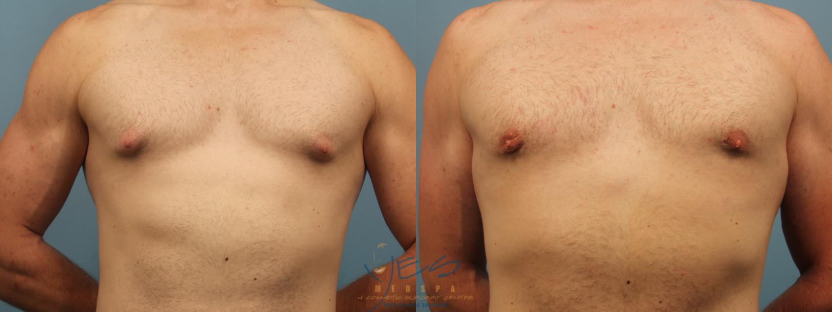 Before & After Male Breast Reduction Case 303 Front View in Vancouver, BC