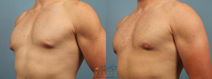Before & After Male Breast Reduction Case 303 Left Oblique View in Vancouver, BC