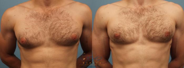 Before & After Male Breast Reduction Case 318 Front View in Vancouver, BC