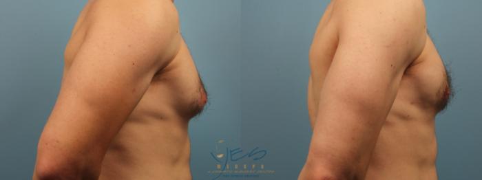 Before & After Male Breast Reduction Case 318 Right Side View in Vancouver, BC
