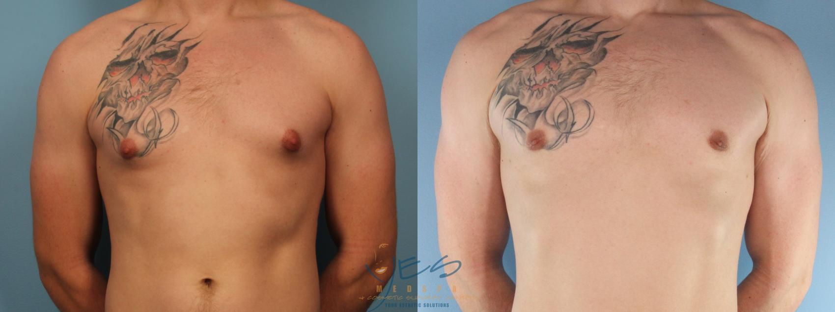 Before & After Male Breast Reduction Case 383 Front View in Vancouver, BC