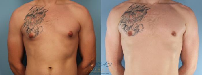 Before & After Male Breast Reduction Case 383 Front View in Vancouver, BC