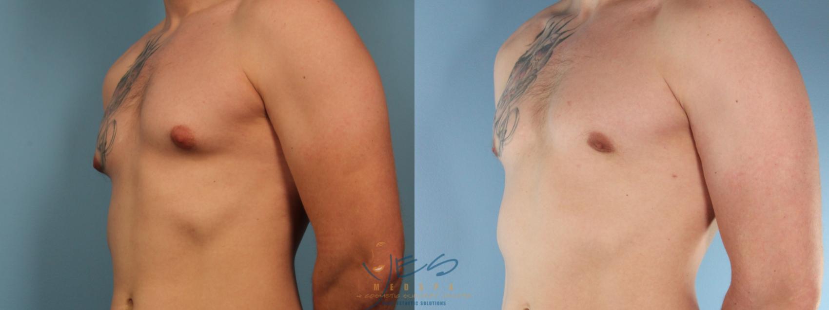 Before & After Male Breast Reduction Case 383 Left Oblique View in Vancouver, BC