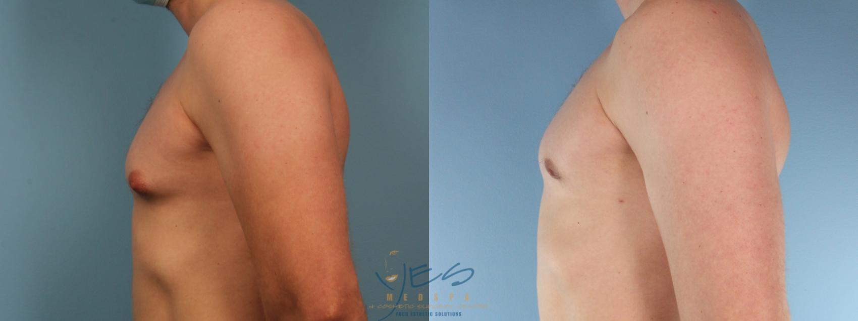 Before & After Male Breast Reduction Case 383 Left Side View in Vancouver, BC