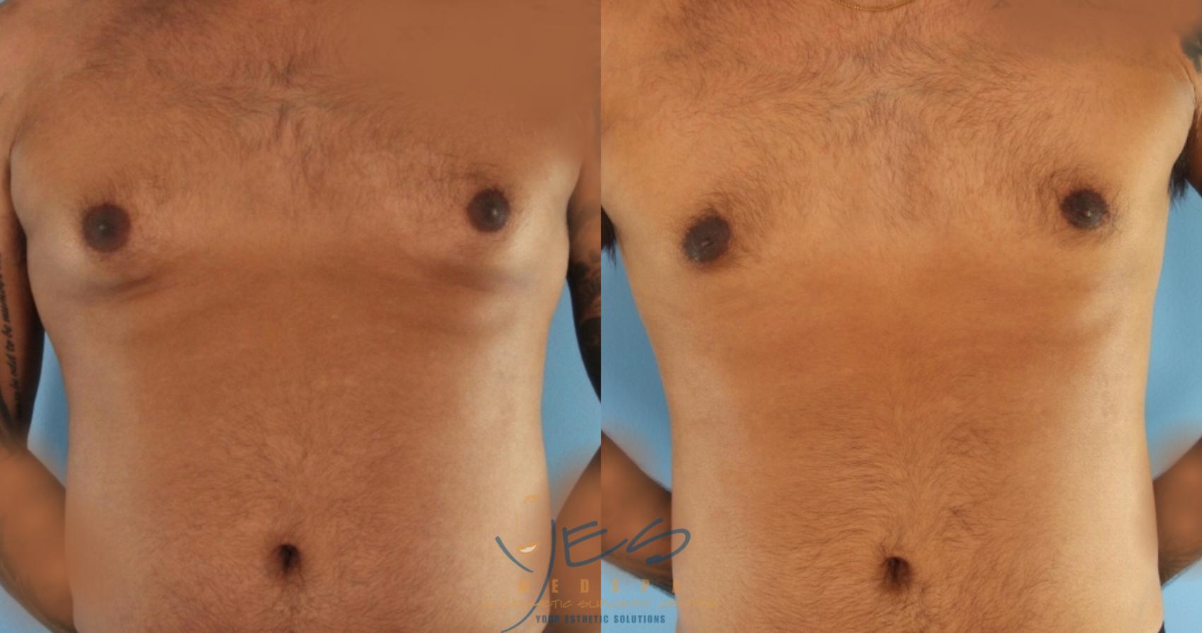 Before & After Male Breast Reduction Case 453 Front View in Vancouver, BC