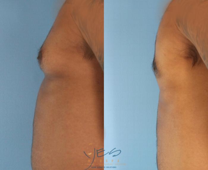 Before & After Male Breast Reduction Case 453 Left Side View in Vancouver, BC