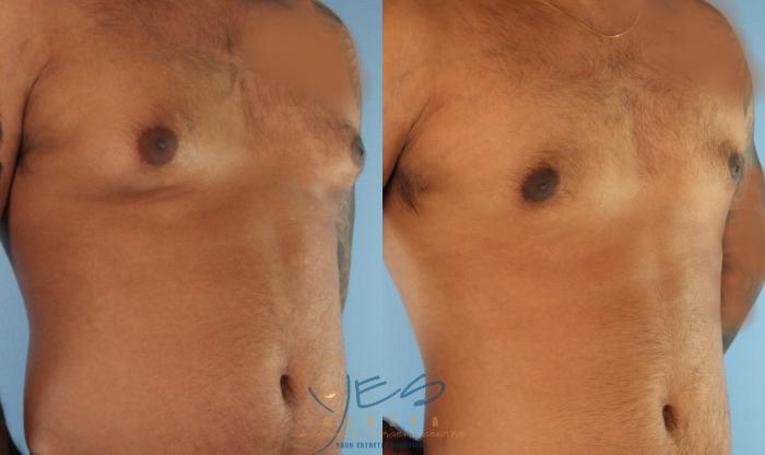 Before & After Male Breast Reduction Case 453 Right Oblique View in Vancouver, BC