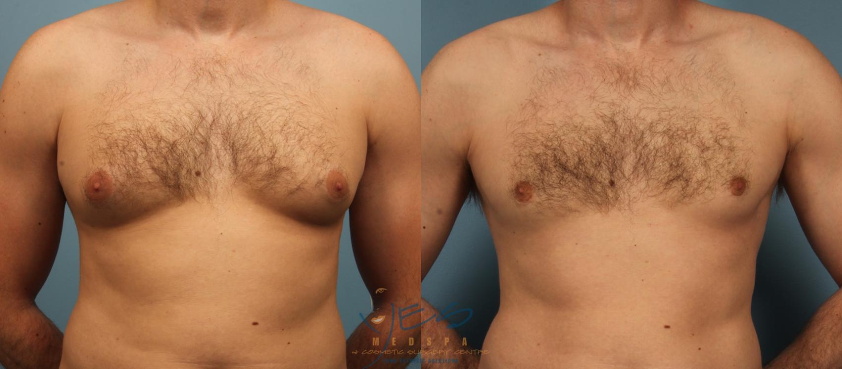 Before & After Male Breast Reduction Case 457 Front View in Vancouver, BC