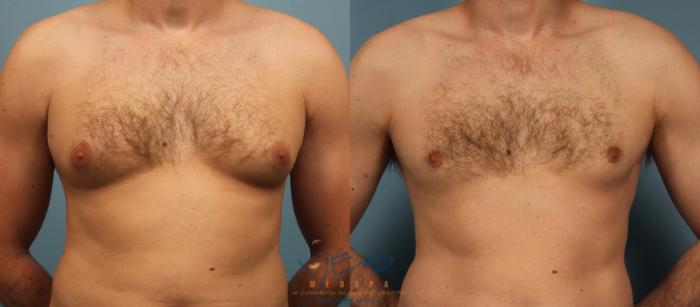 Before & After Male Breast Reduction Case 457 Front View in Vancouver, BC