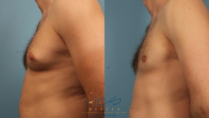 Before & After Male Breast Reduction Case 457 Left Side View in Vancouver, BC
